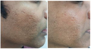Acne Scar Treatment With Laser