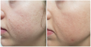 Acne Scaring Treatment With Laser