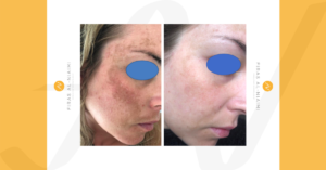 Acne Scarring Treatment