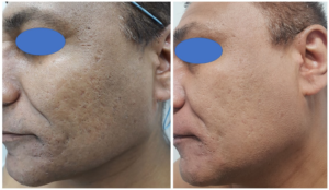 Acne Scarring Treatments