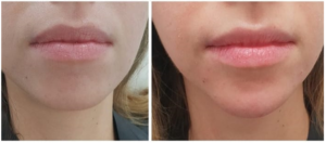 Chin Lengthening With Fillers