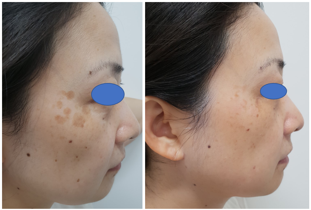smugling sti Billy Laser Treatment For Pigmentation In Asian Skin - Dr Firas Al-Niaimi