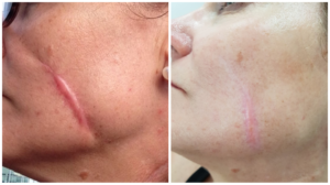 Scar Treatment With Dr Firas