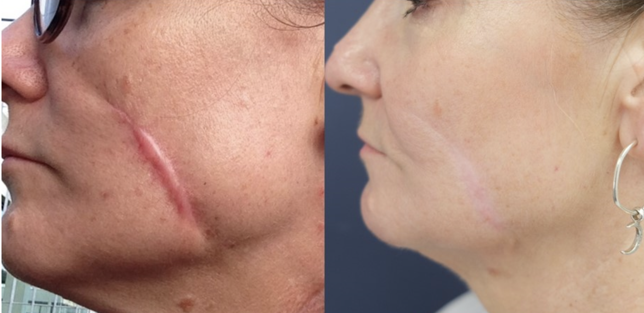 Pulse Light Clinic - Our clients recovery journey with CO2 laser for acne  scar removal ​- ​What is the CO2 Laser? - The CO2 laser is a fractional  treatment for skin rejuvenation