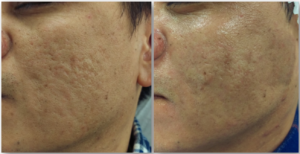 Subcision For Acne Scarring
