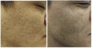 Subcision Treatment For Acne Scars