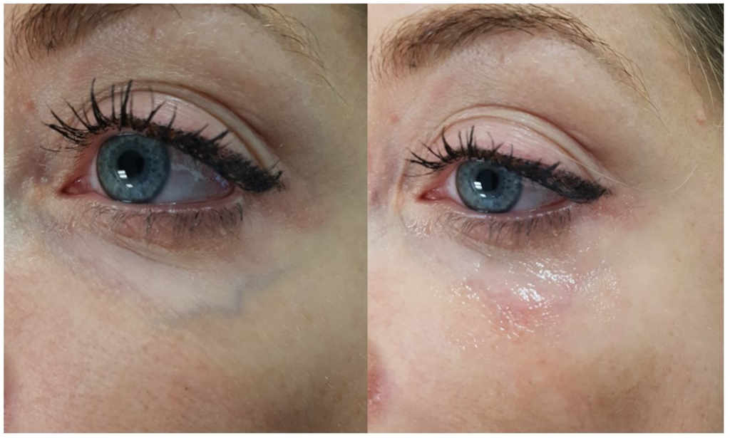 Undereye Veins Treatment Dr Firas AlNiaimi