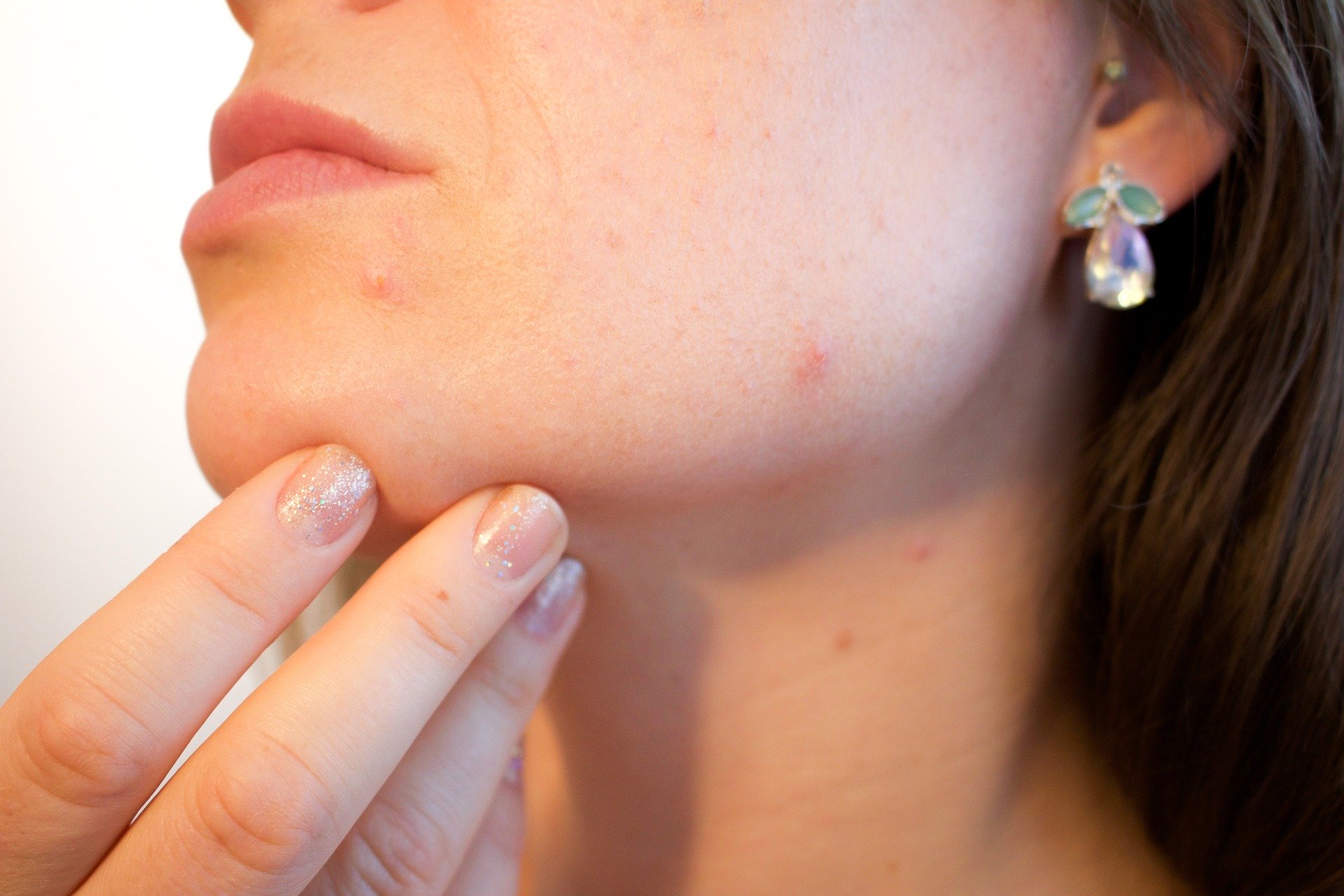 Smooth Your Acne Scars With Laser Treatment