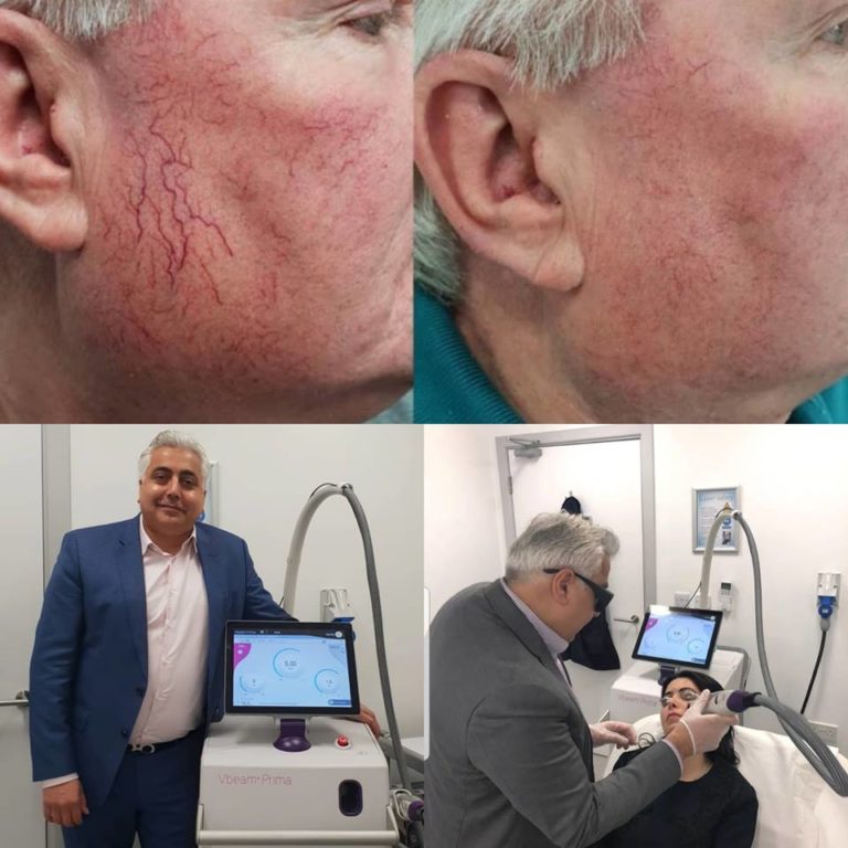 Vbeam® Prima with Dr Firas AlNiaimi Vbeam® Prima London